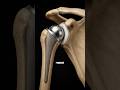 How Occupational Therapists Safely Restore Grip and Upper Body Function #PainManagement #doctor