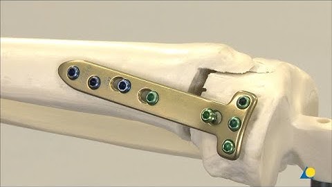 Tibia, Proximal - Malalignment and Deformity - Biplanar Open-Wedge Osteotomy - Using MHT Plate