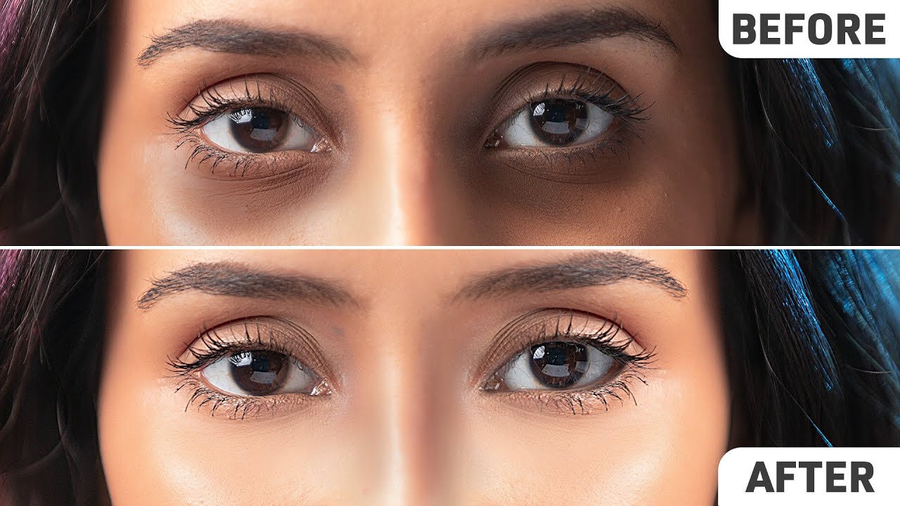 eyes dark circles before after