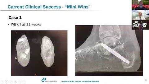 MedShape WEBINAR: The DynaNail Mini® Fusion System