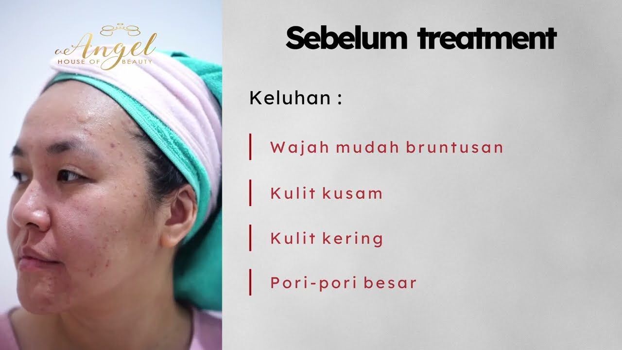 Mochi Skin di Angel Clinic untuk kamu yang bruntusan dan mulai penuaan dini dengan kulit yang kusam
