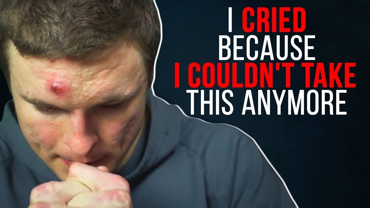 10 YRS OF BOTTLED UP EMOTION FROM SUFFERING WITH ACNE