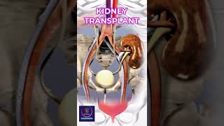 Kidney Transplant Procedure: Steps, Recovery, and Success Rate Explained