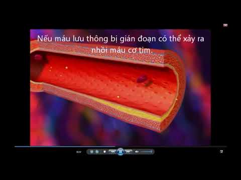 xơ vữa động mạch - nhồi máu cơ tim