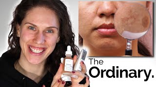 THE ORDINARY - 3 BEST DARK SPOTS & PIGMENTATION PRODUCTS