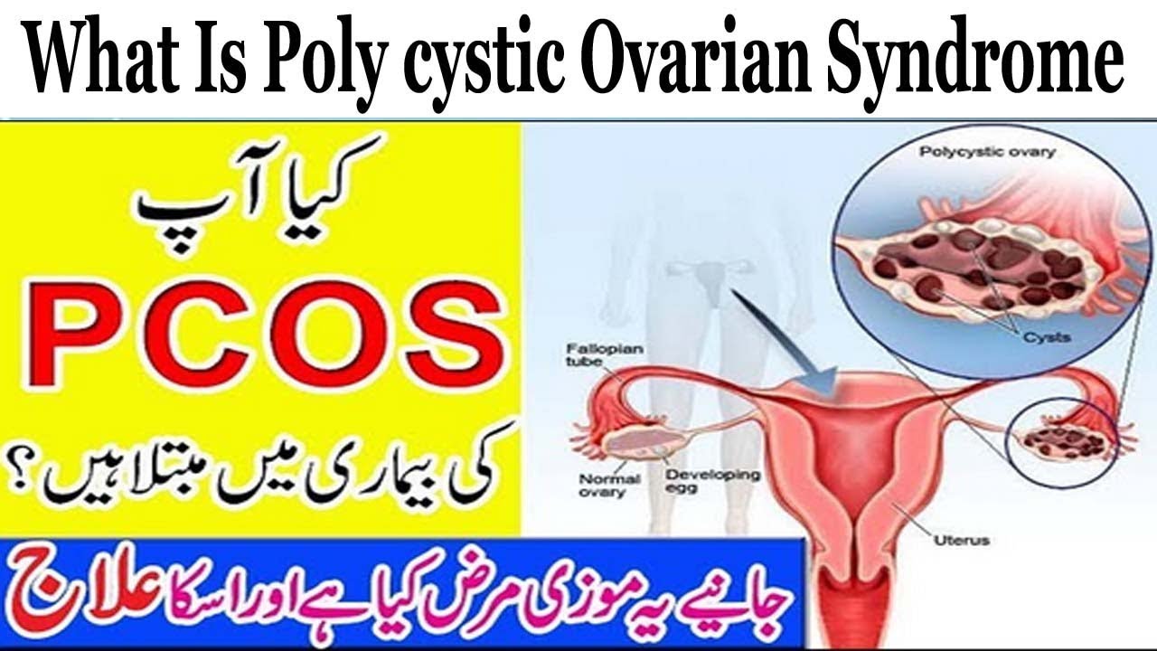 Women Health | What Is Poly cystic Ovarian Syndrome PCOS Hormones ...