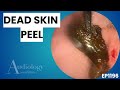 Extreme Ear Wax Removal | Dead Skin & Clay-Like Plug Extraction - EP1196