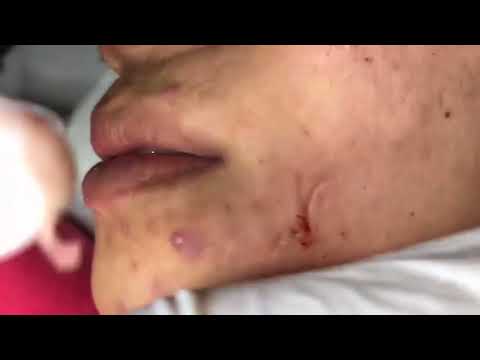 VERY BIG ACNE EXTRACTION - Blackheads Removal