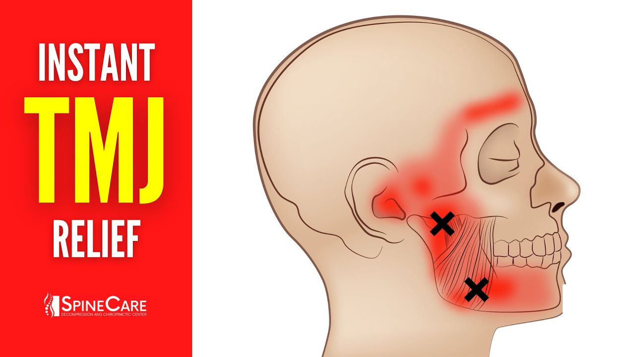 How to Relieve TMJ Pain at Home 30 SECOND RELIEF picture