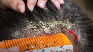 Removed Hundred of Lice From Head and Dry Scalp Huge Dandruff of Flakes Removal With Comb # 1765