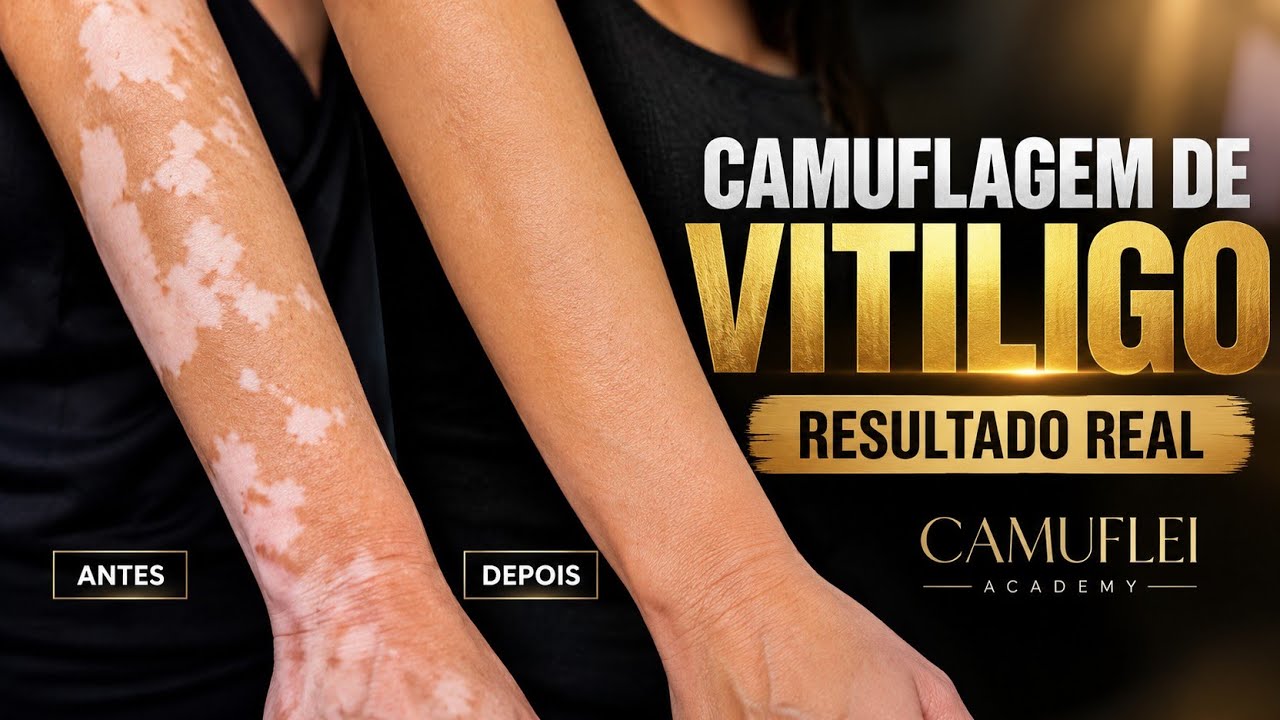 Camuflagem de Vitiligo — Camuflei