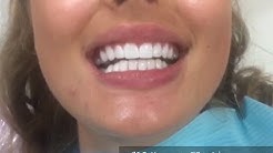 Check Out Veneers In Dubai For A Better Smile!