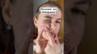 Обсыпало все ПРЫЩАМИ сыворотка 142054898 крем 154859673 проблема решение прыщи