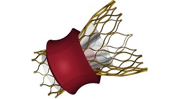 Transcatheter aortic valve implant TAVI - FEA Simulation