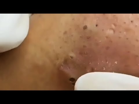 WOOW  BLACKHEADS REMOVAL FROM THE NOSE  2  relaxing   blackheads