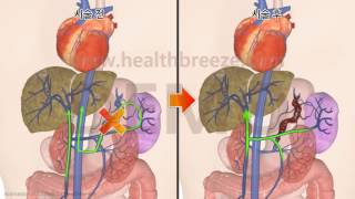[Demonstration] c0243aako Retrograde Transvenous Gastric Variceal Occlusion Guide BRTO