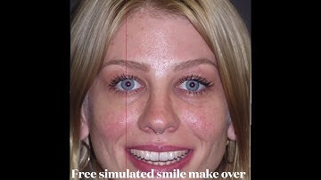 Bioclear Uveneers | Same Day Smile | Learn How It