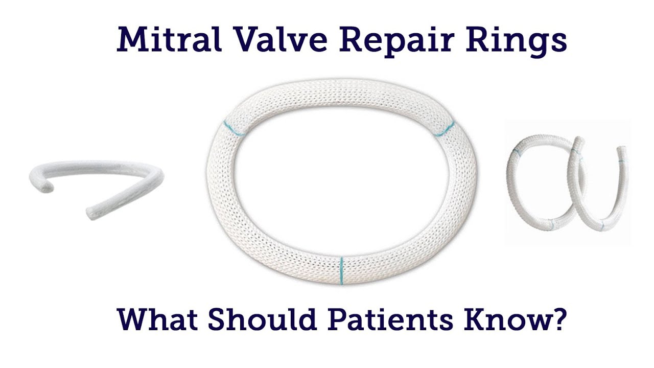 Annuloplasty valve repair heart