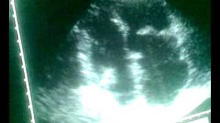 MASS  IN  RIGHT ATRIUM..mp4