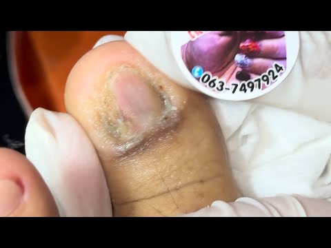Ep_6272 Foot nails skin removal 👣 เวลาคัน..มีวิธีช่วยไหมคะ 😄 (clip from Thailand)