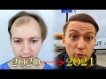 Fue hair transplant growth timeline  before  after
