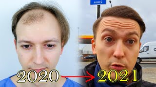 FUE Hair Transplant Growth Timeline | Before \& After