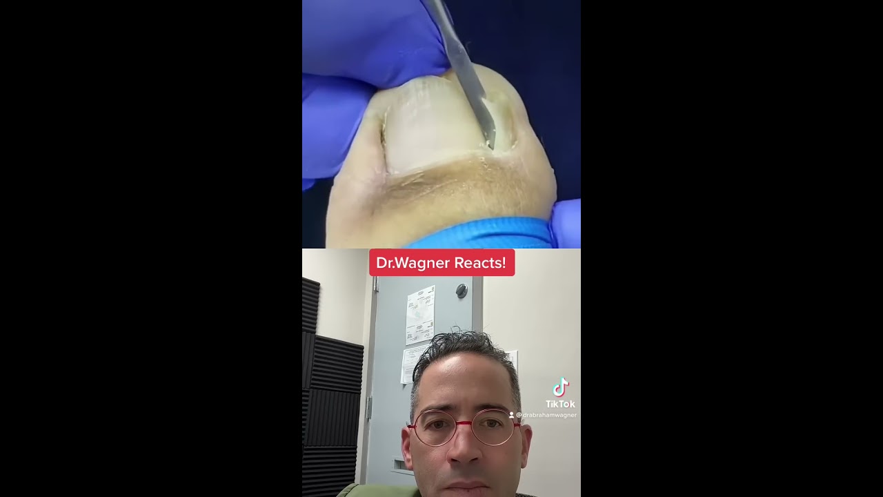 COLOSSAL INGROWN TOENAIL Shorts Ingrowntoenail