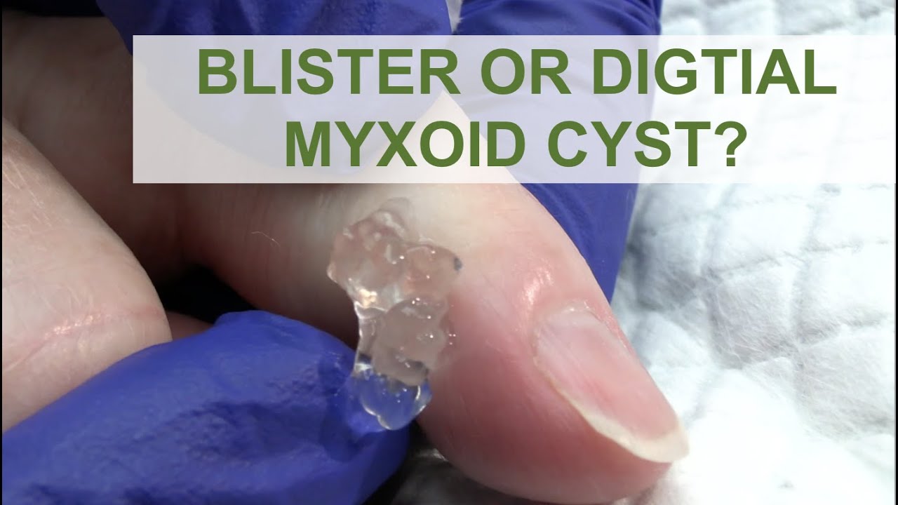 Blister Or A Digital Myxoid Cyst Dr Derm Youtube