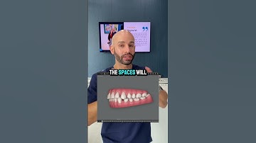Critical Invisalign Technique for Closing Spaces for Our Patient.