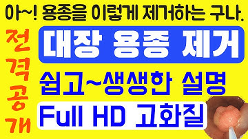 대장 용종 제거 영상, Full HD 고화질, 쉽고 생생한 설명