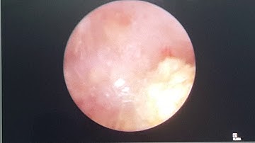 TÁN SỎI THẬN QUA DA. Ngày 7/8/2019. TTUT. TS.BS. Dương Van Trung ☎0913534343