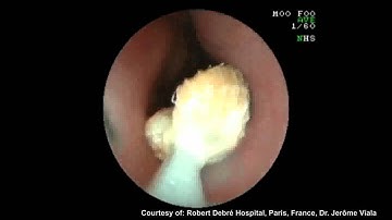 ROTH NET™ Mini Retriever: Foreign Body Retrieval