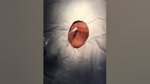 Erector Spinae Block With Landmark Guided Technique SIMPLIFYING NERVE BLOCKS (SNB) SERIES  BLOCK 1