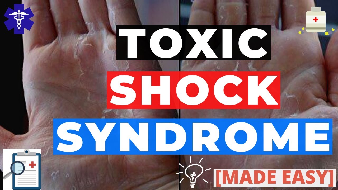 Toxic Shock Syndrome  Concise Medical Knowledge