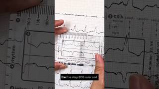 5 Step ECG Ruler for Fast ECG Strip Interpretation - Available now in India on Amazon.in Wealth