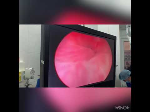 U xơ tuyến tiền liệt / u phì đại tuyến tiền liệt / phẫu thuật nội soi cắt u xơ tuyến tiền liệt