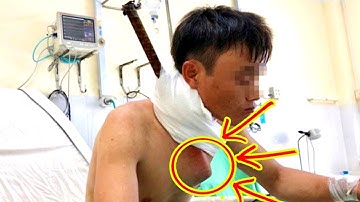 HY HỮU cứu sống công nhân bị cây sắt ĐÂM XUYÊN CỔ xuống ngực