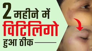 2 महन म सफद दग हए ठक