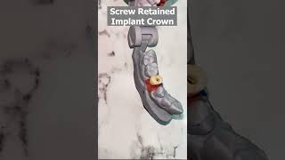 Dental Implant with Screw Retained Zirconia Prosthesis