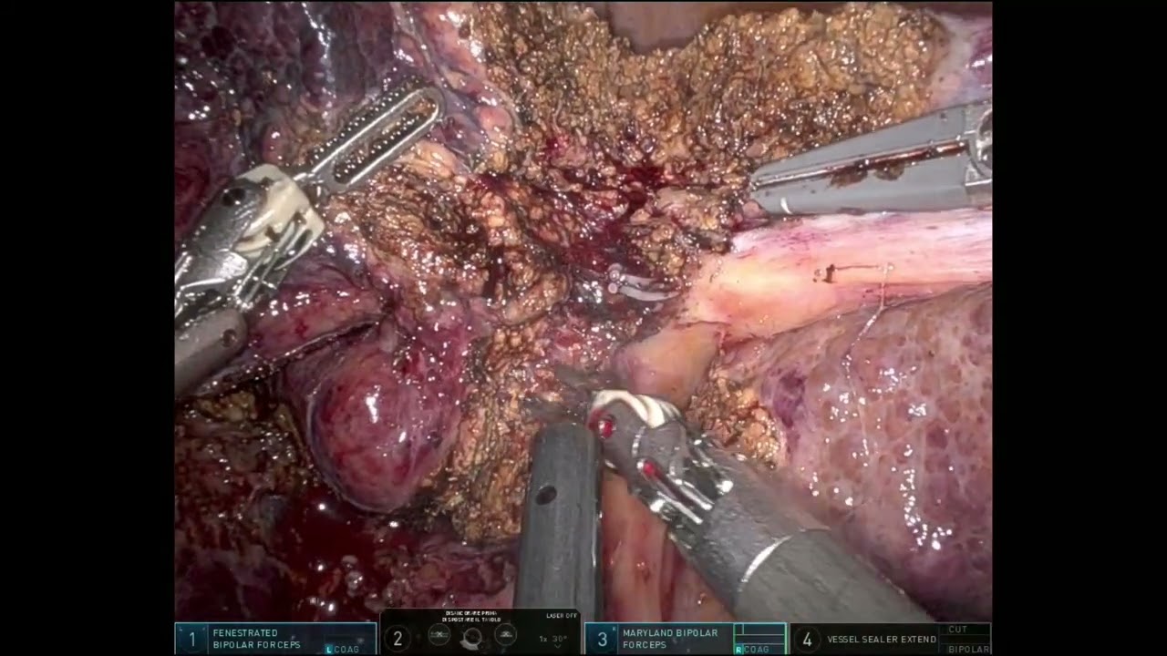 Robotic resection oh HCC in cirrhotic liver