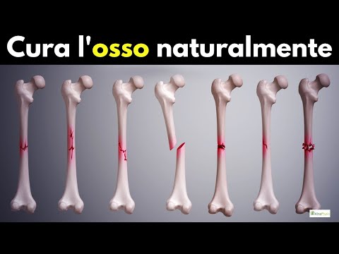 come stimolare il callo osseo (per frattura non consolidata!)