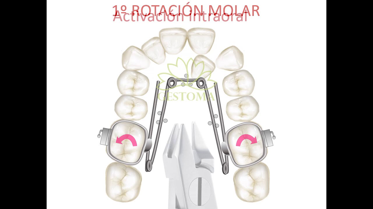 Manejo Quad Helix en Ortodoncia Gestoma YouTube