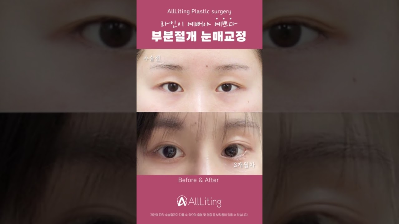 THẨM MỸ VIỆN OLITING] #Nângcơmắt bạn thấy ngại à? Không sao đâu nhé #Nângcơmắt_rạchmộtphần cũng có thể làm bạn xinh đẹp lên rất nhiều đó👍 #vlognângcơmắt #bệnhviệnchuyêmnângcơmắt #địachỉnângcơmắtđẹptạiGangnam #phòngkhámtạothình