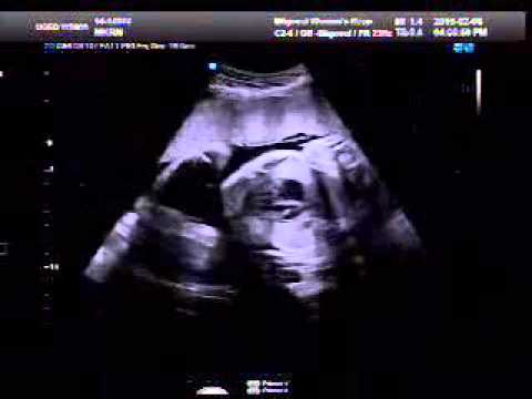32-weeks-(8months-)-ultrasound-baby-boy