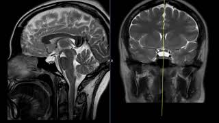 Pseudotumor cerebri (elevated intracranial pressure)