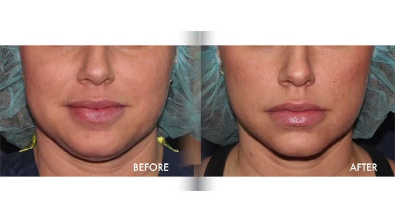 Banner for San Diego ThermiLift Patient Testimonial | Cosmetic Laser Dermatology