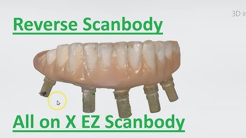 Reverse Scanbody for All-on-X Scanning – Simplified Workflow