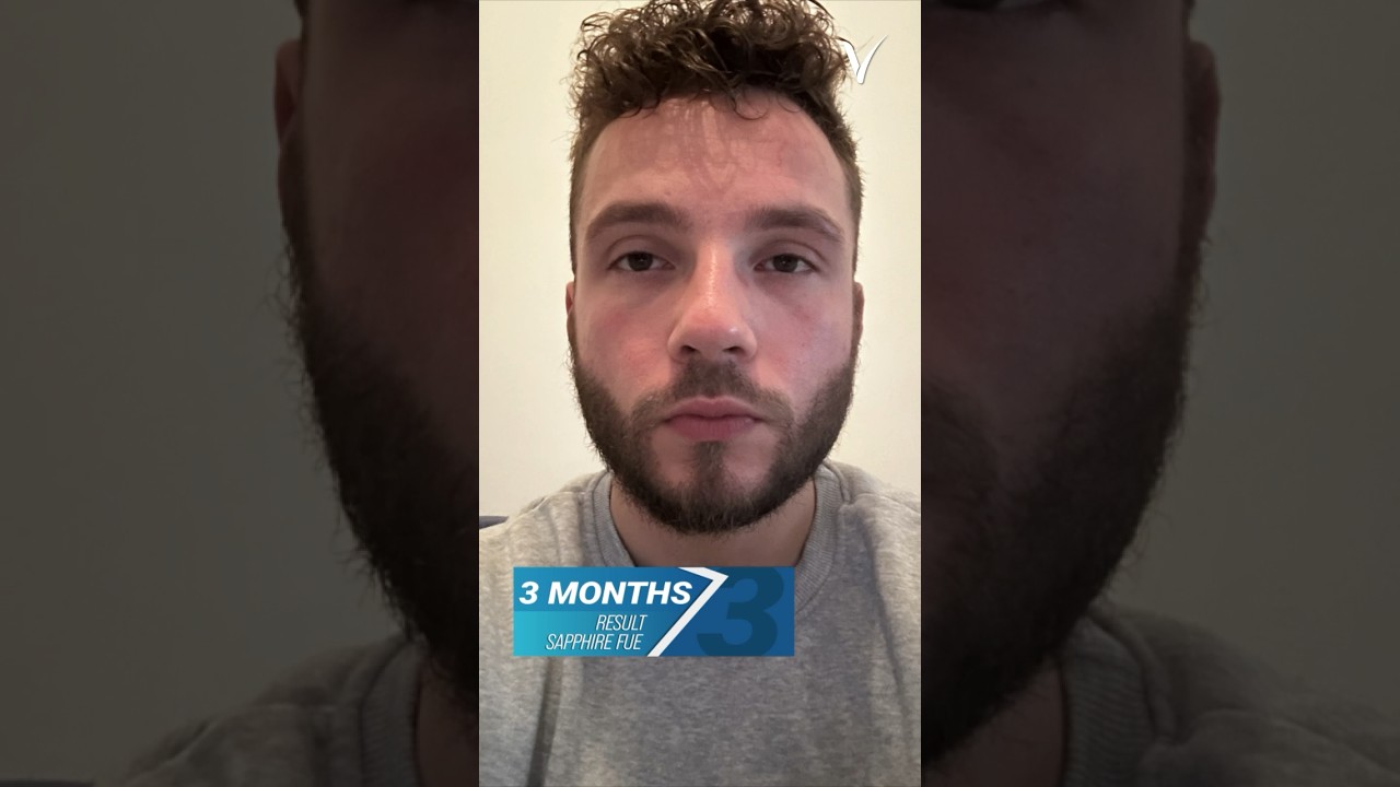 Sapphire FUE Beard Transplant Before and After 1670 Grafts 