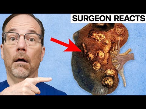A Man Overdosed Vitamin D. This Is What Happened 😱 Surgeon Reacts