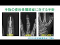 手指の変形性関節症に対する手術 （2025.6 日本抗加齢医学で報告）